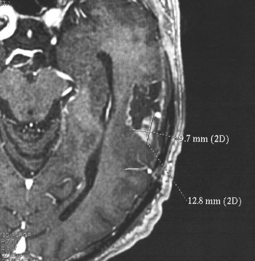 "Qu'est-ce qu'il a cet homme ? Un glioblastome" Avr-Déc 2014